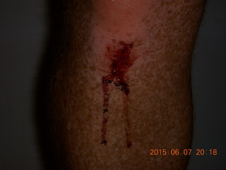 my knee after a bike fall