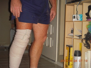 two days after my knee surgery