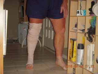 after knee operation + Adam