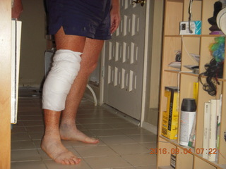 two days after my knee surgery
