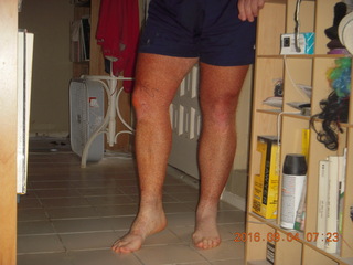 two days after my knee surgery