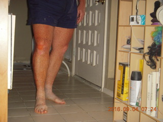 two days after my knee surgery