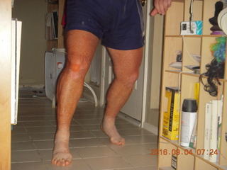 after knee operation + Adam walking away with cane