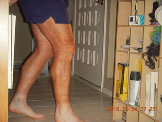 two days after my knee surgery