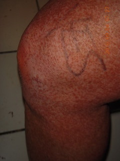 two days after my knee surgery