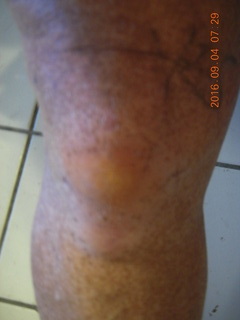 two days after my knee surgery (with my cat Max)