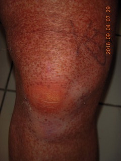 two days after my knee surgery