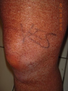 two days after my knee surgery