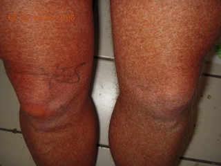 two days after my knee surgery