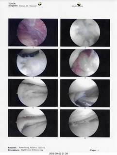 two days after my knee surgery