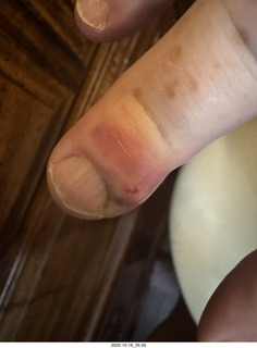 Adam's infected finger