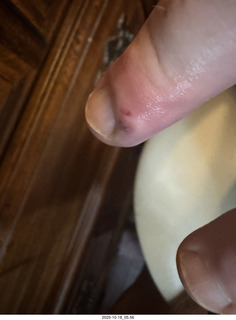 Adam's infected finger