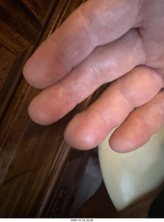 Adam's infected finger