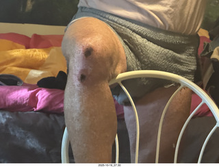 Adam's infected finger